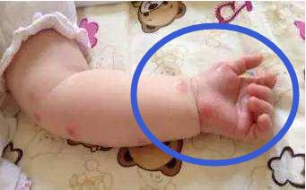 宝宝手起脓泡是怎么回事,婴儿手肿起好多小泡