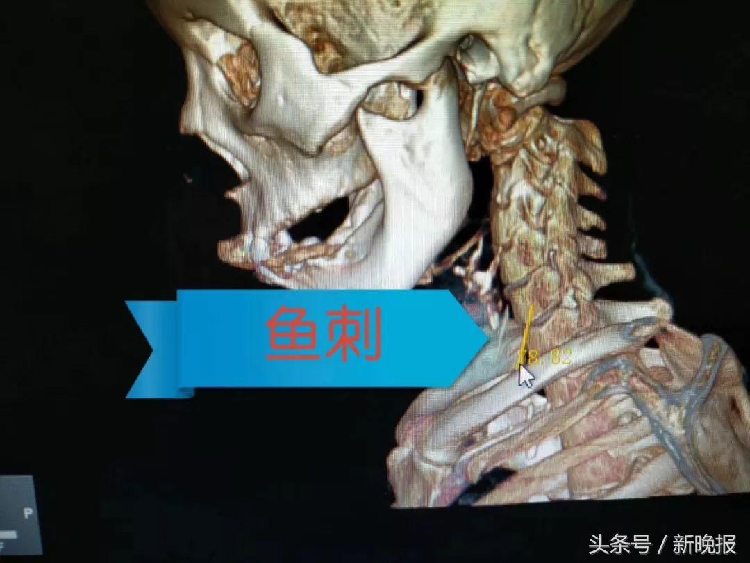 误吞鱼刺，这个习惯性动作很危险！大妈颈部被切开才救回了命