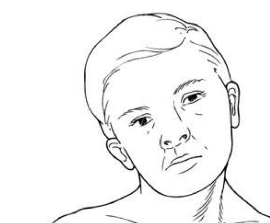 歪脖治疗,歪脖病是什么原因引起的