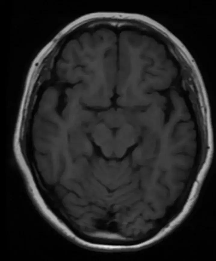 复旦大学附属中山医院放射科病例讨论（八十四）