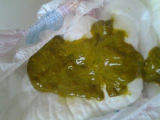 如何判断宝宝大便是否正常,怎么判断宝宝大便是否正确