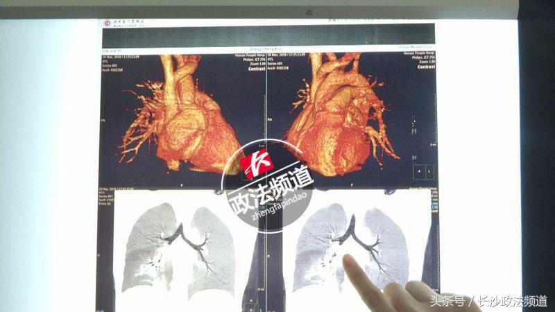 12岁男孩吃得很多体重突然下降,12岁男孩突然体重下降而且发热