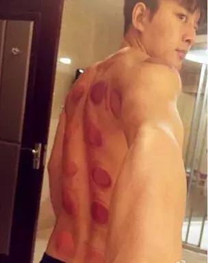 触目惊心！杨丞琳阿娇等人把刮痧过度神话，专家打脸：根本没效果