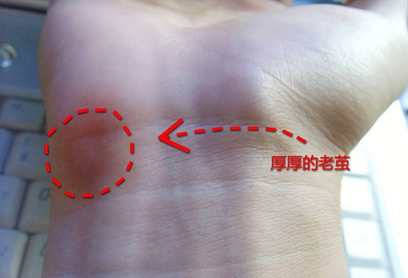 每天握鼠标手疼怎么办呢,鼠标手小臂酸痛怎么缓解