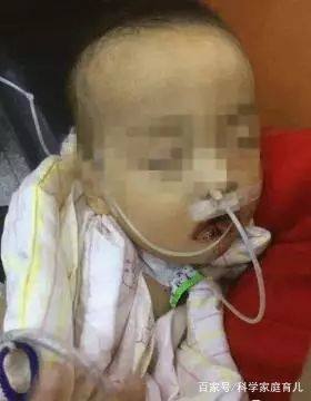 儿童误食火碱受伤,男童误吞火碱