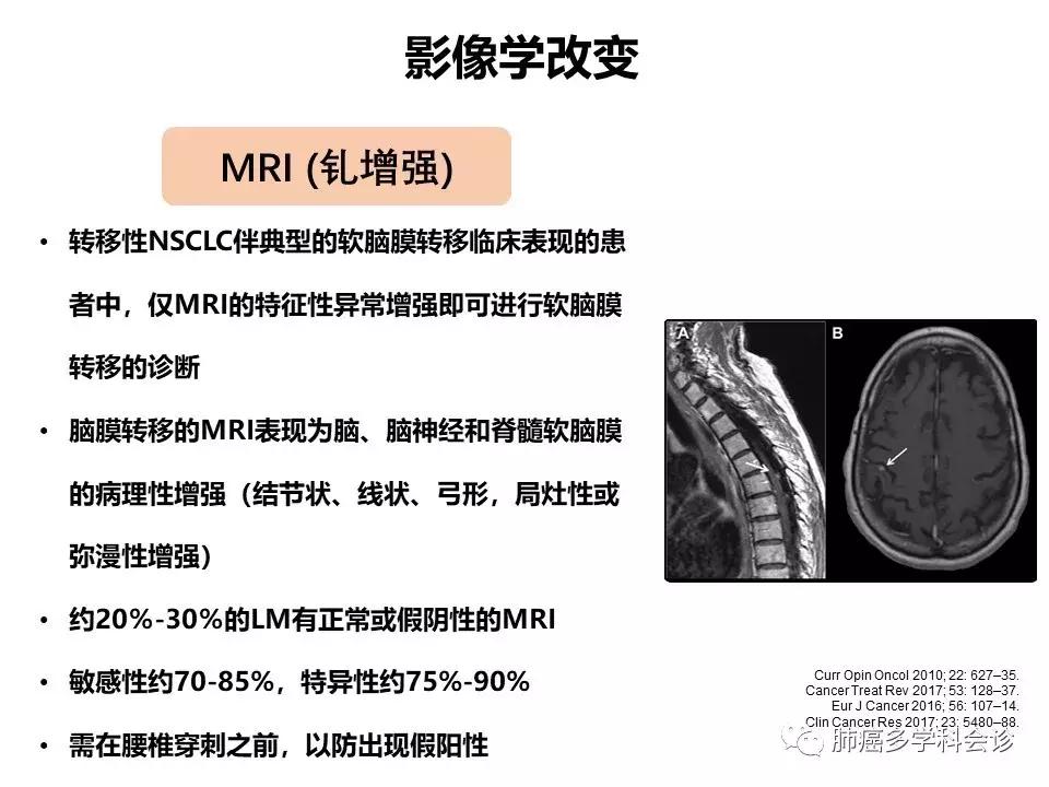 【宣晟医疗】肺癌脑膜转移的诊断方法及研究进展