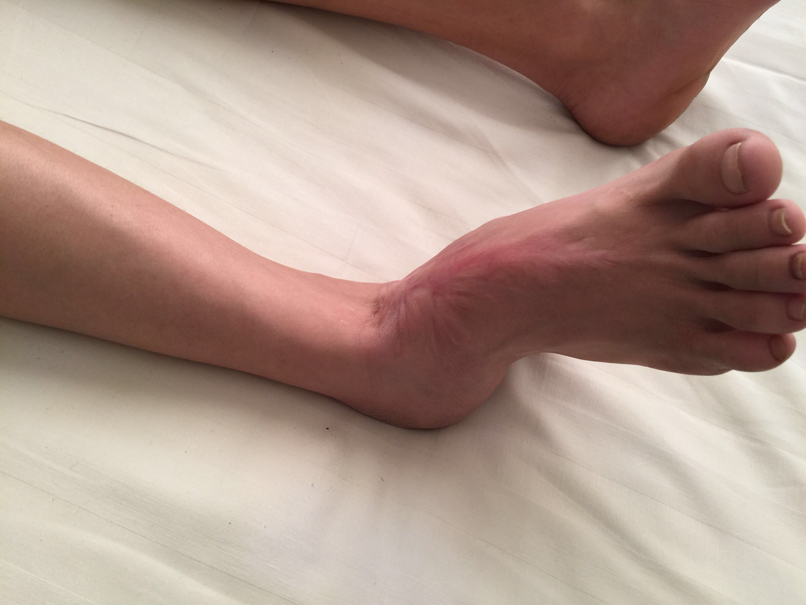 儿童骨骺受损后果严重吗,儿童损伤导致骨骺线闭合