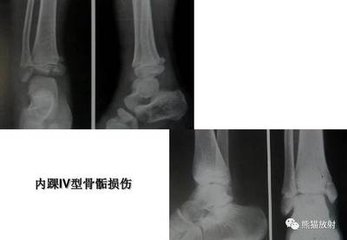 儿童骨骺受损后果严重吗,儿童损伤导致骨骺线闭合