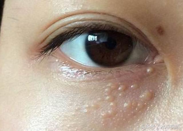 眼角脂肪粒怎么消除,眼角的脂肪粒怎么去除小妙招