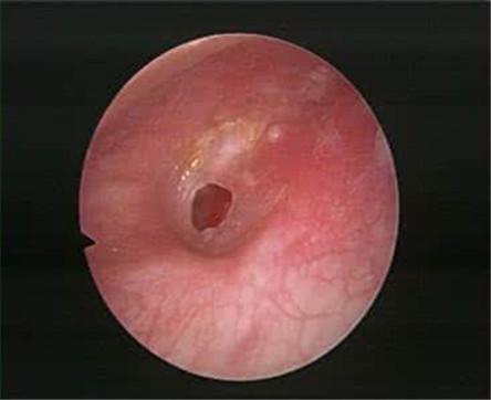 夫妻打架导致耳膜穿孔违法吗,打架致耳膜穿孔谁的责任
