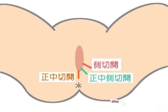 为什么剖腹产那么可怕,顺产撕裂与剪一刀哪个好点