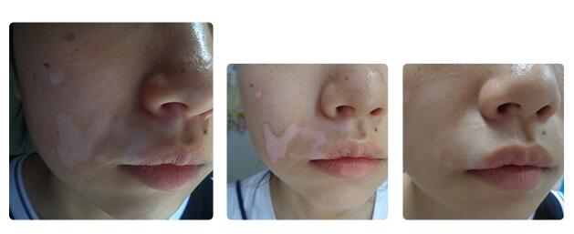 白癜风一般治疗多久能康复,白癜风治疗要多久才能完全治好