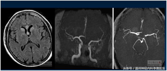 张景明教授讲脑中风后遗症,李医生讲中风视频全集