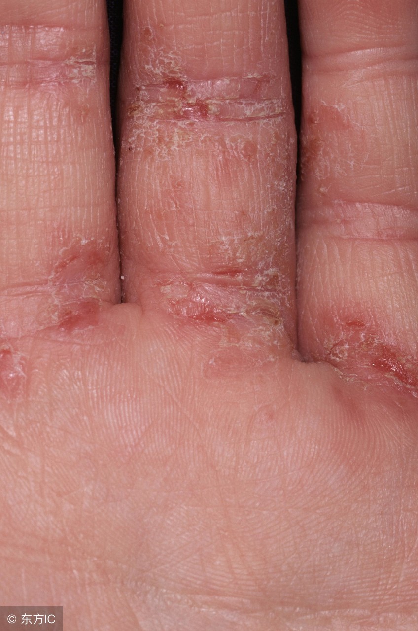 脂溢性皮炎毛囊炎外用药哪个好用,脂溢性皮炎头皮屑多用什么外用药