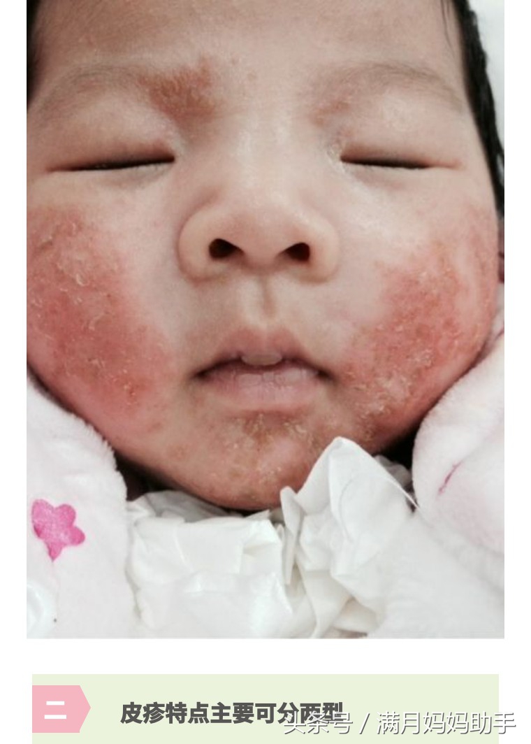 宝宝胳肢窝起红疹子什么原因,宝宝胳肢窝红图片