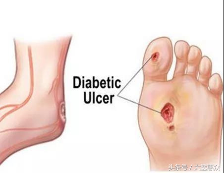 怎么治疗烂脚烂骨,烂脚缝有什么快速根治的方法吗