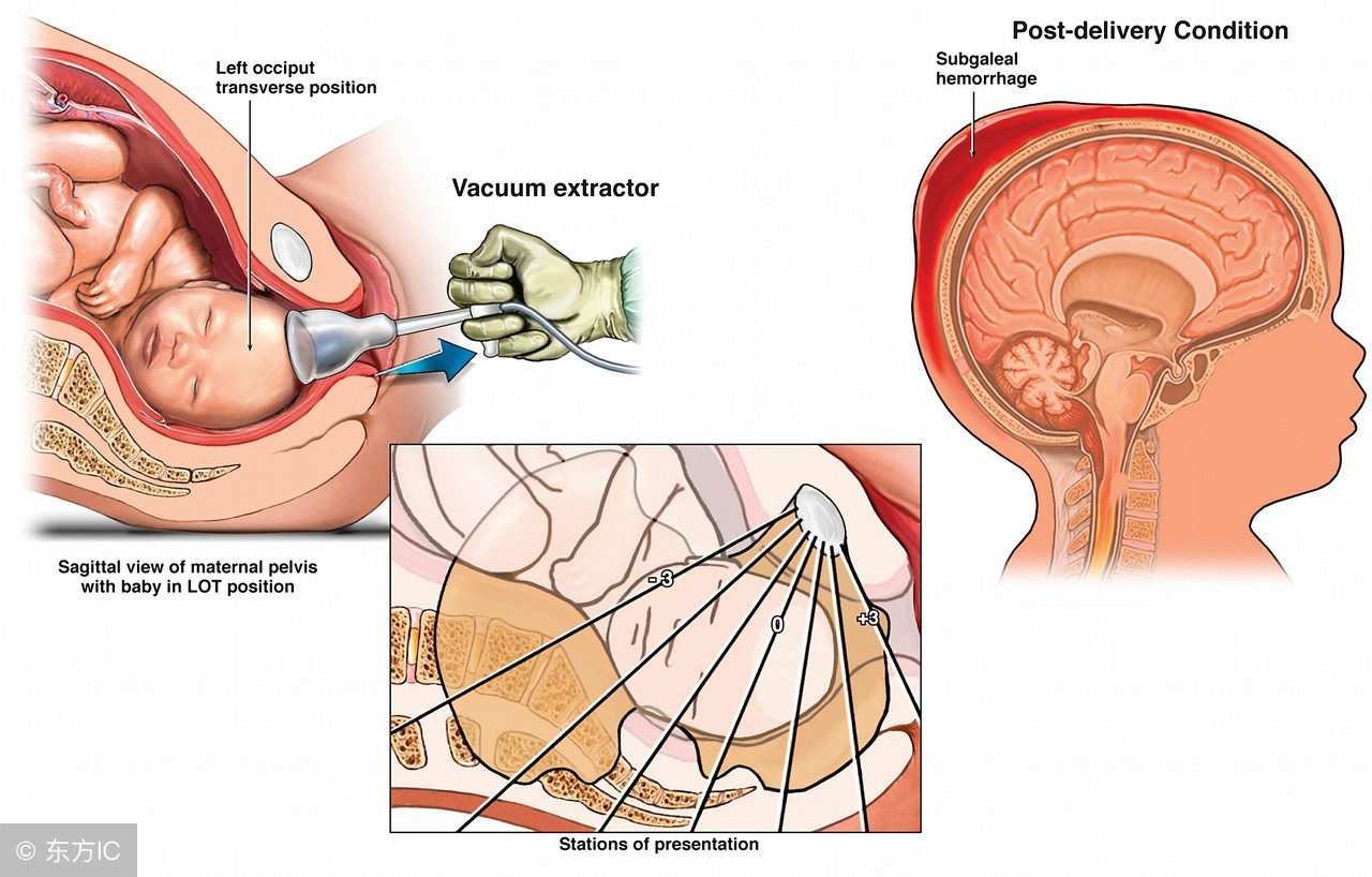 可怕的胎停育，是怎么回事？