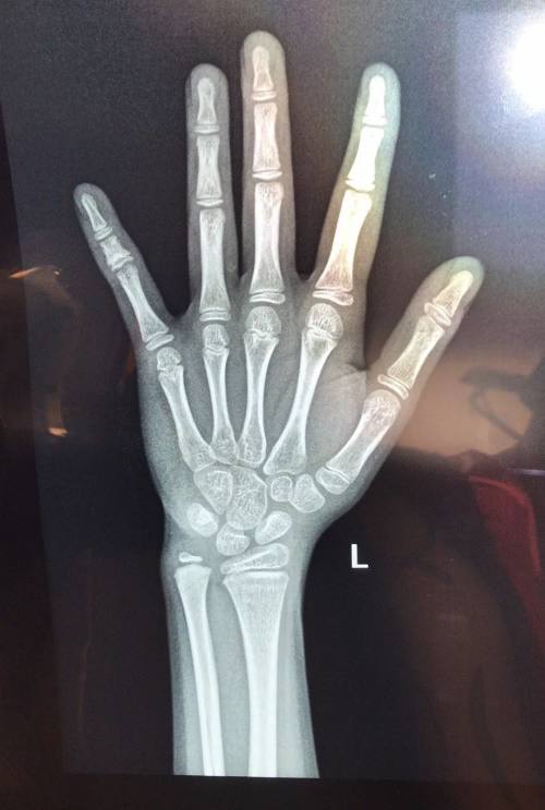 孩子检查正常就是比同龄人矮很多,小孩比同龄人矮需要去医院检查啥