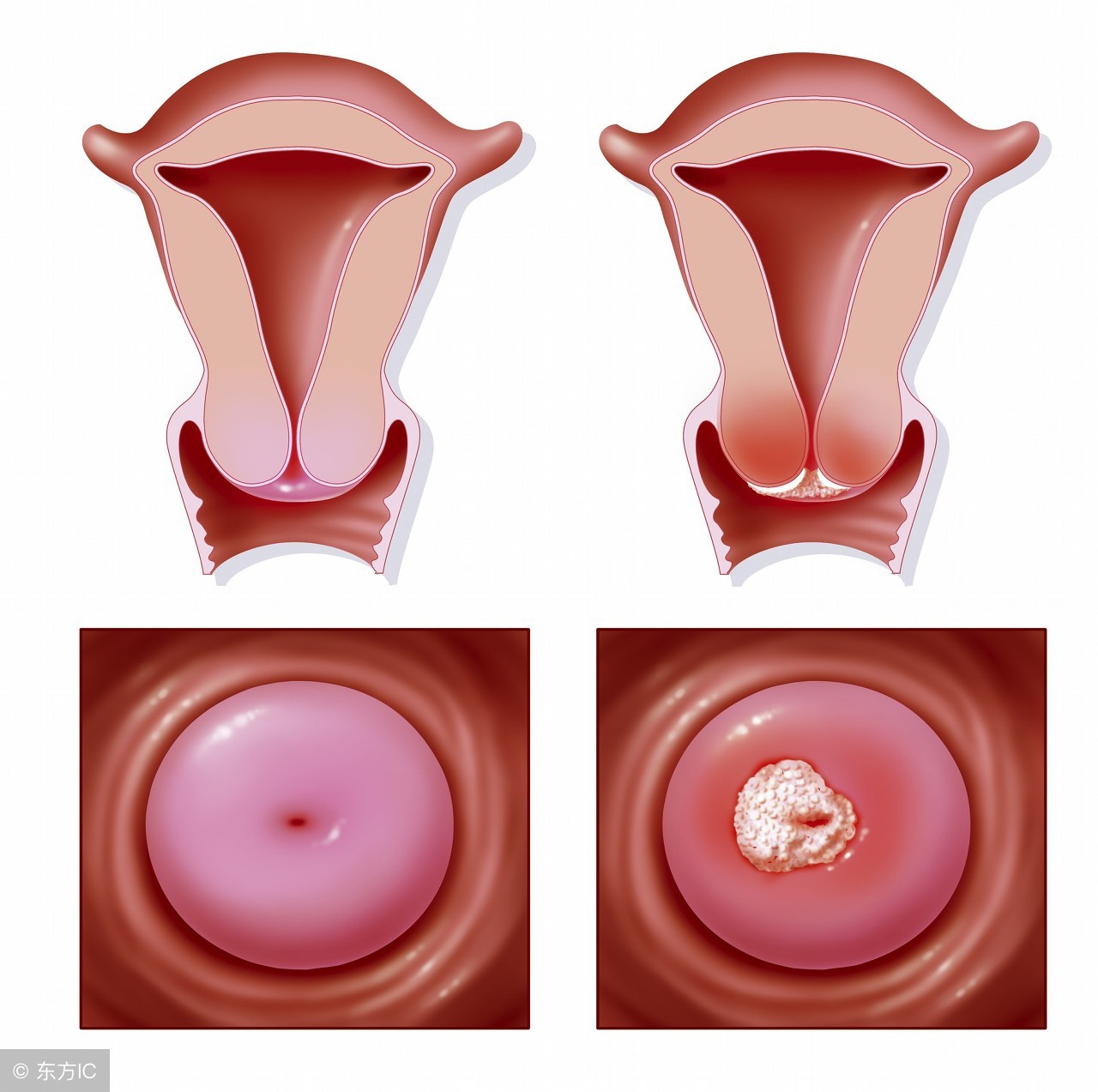 宫颈癌的医学诊断依据