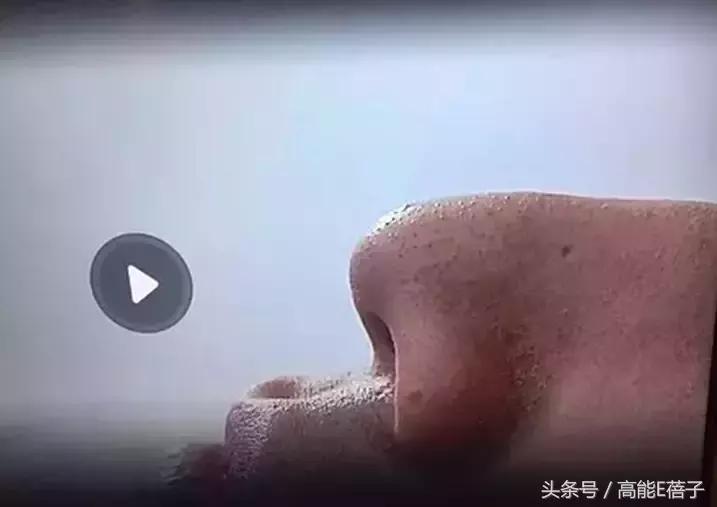 蔡徐坤、Angelababy都根治不掉的黑头，微商神器能去除？