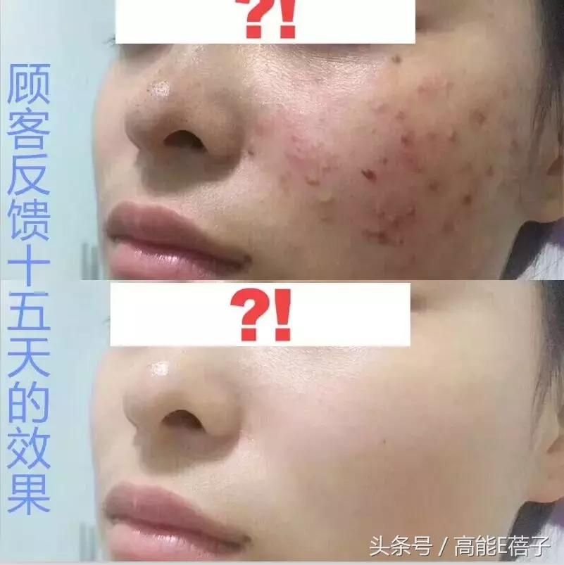 蔡徐坤、Angelababy都根治不掉的黑头，微商神器能去除？