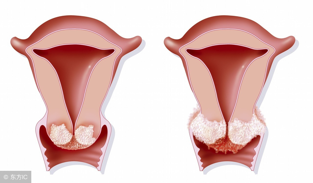 宫颈癌常伴有宫颈糜烂，一定要注重预防