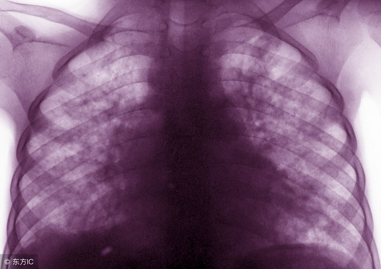 肺结核引起相关临床症状,肺结核病人肺部有什么症状