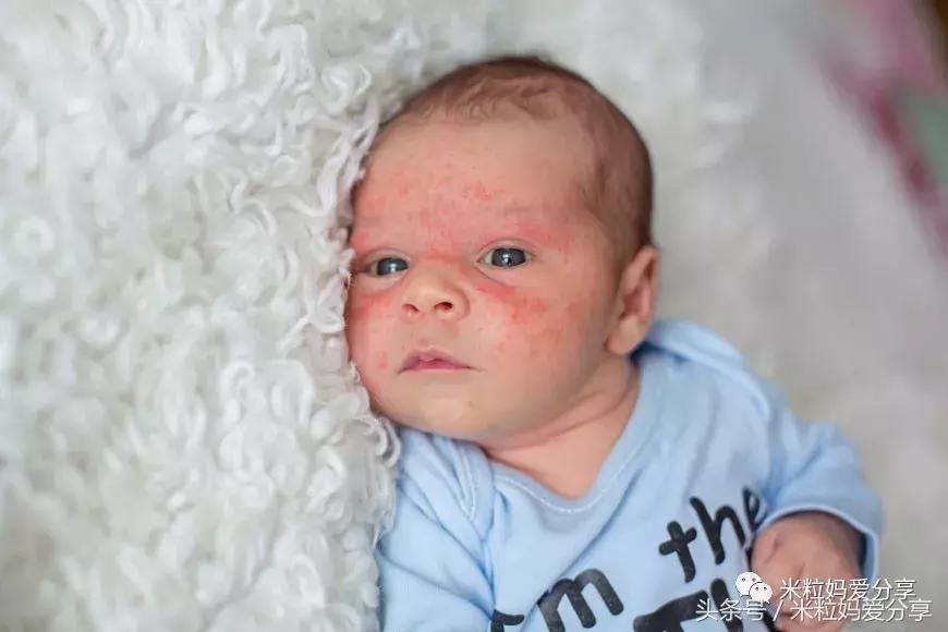 宝宝起疹的最佳治疗方法,孩子发烧后出疹怎么护理