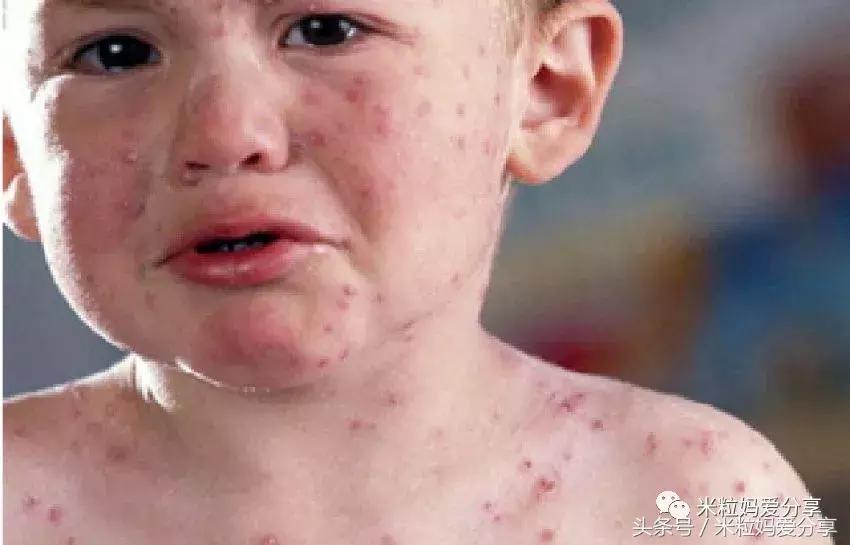 宝宝起疹的最佳治疗方法,孩子发烧后出疹怎么护理
