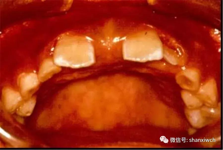 育儿知识关于牙齿,育儿知识幼儿牙齿敏感期