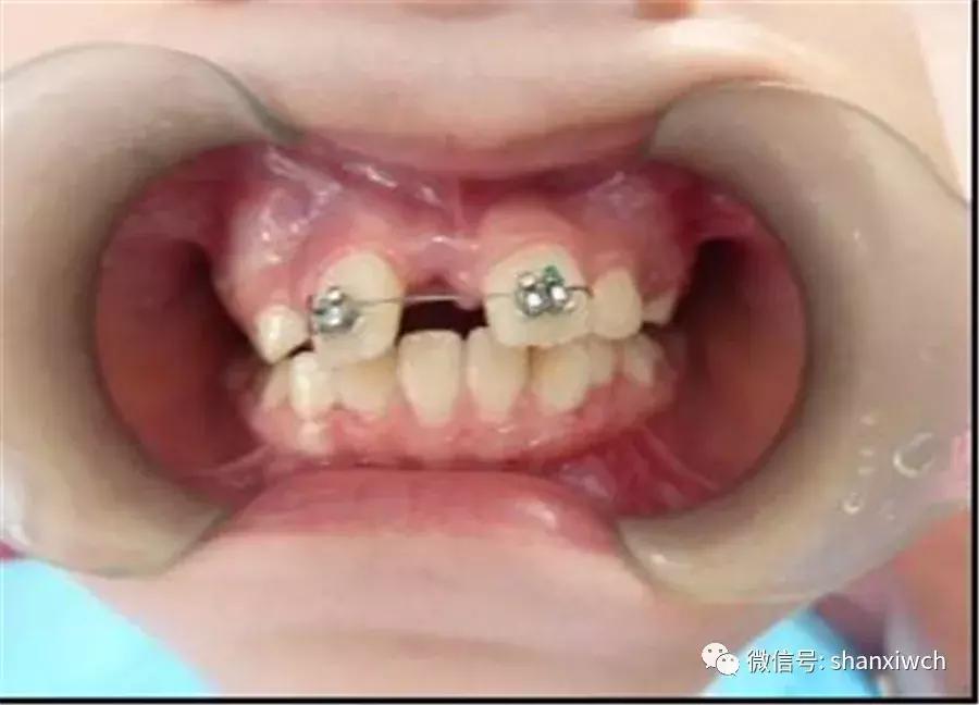 育儿知识关于牙齿,育儿知识幼儿牙齿敏感期