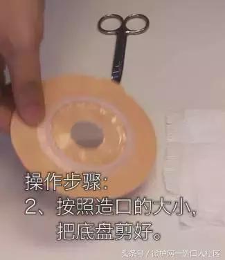 造口护理小窍门视频,更换造口护理技术操作流程