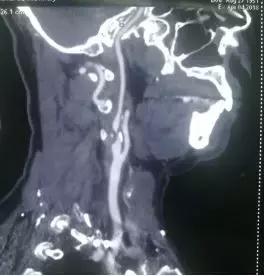 西安市第三人民医院血管外科,治疗颈动脉斑块西安哪家医院好