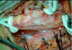 西安市第三人民医院血管外科,治疗颈动脉斑块西安哪家医院好