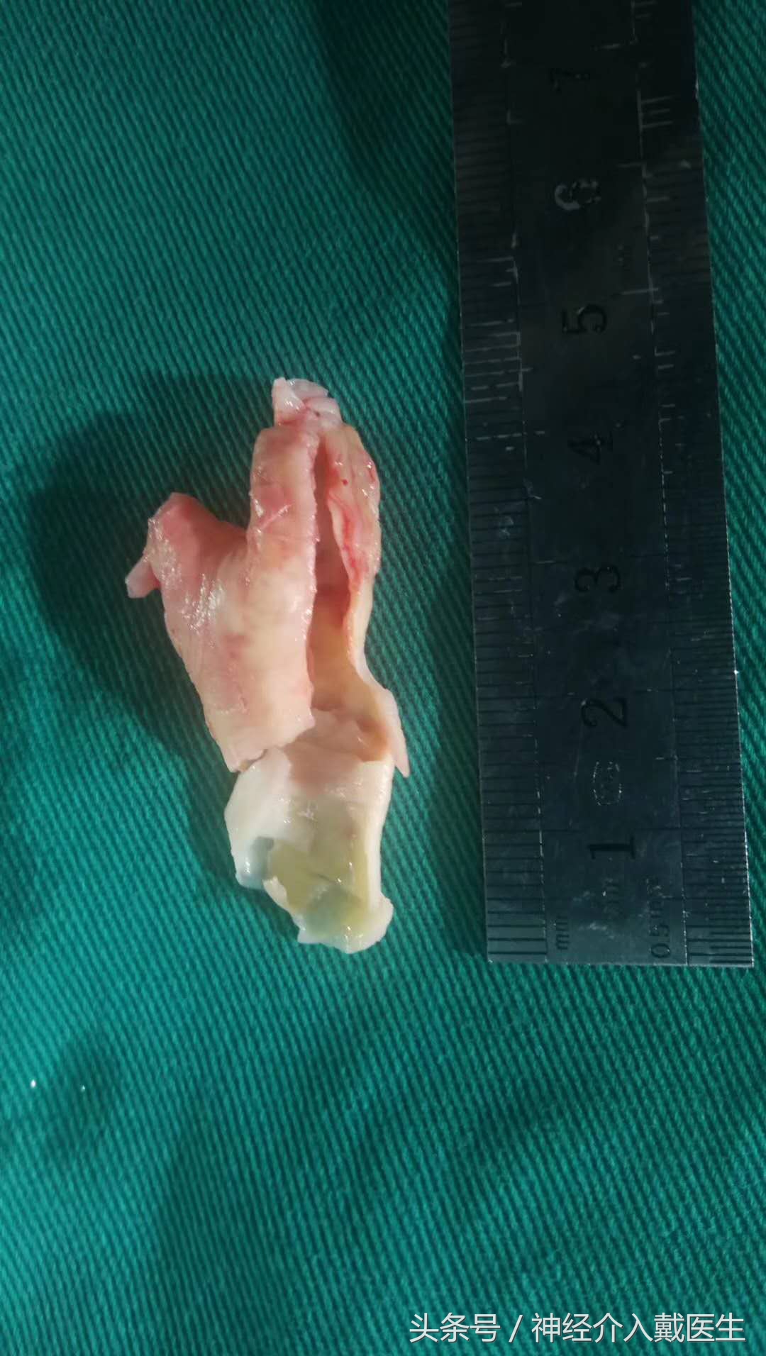 检查脑动脉硬化用什么仪器,脑血管检测仪器