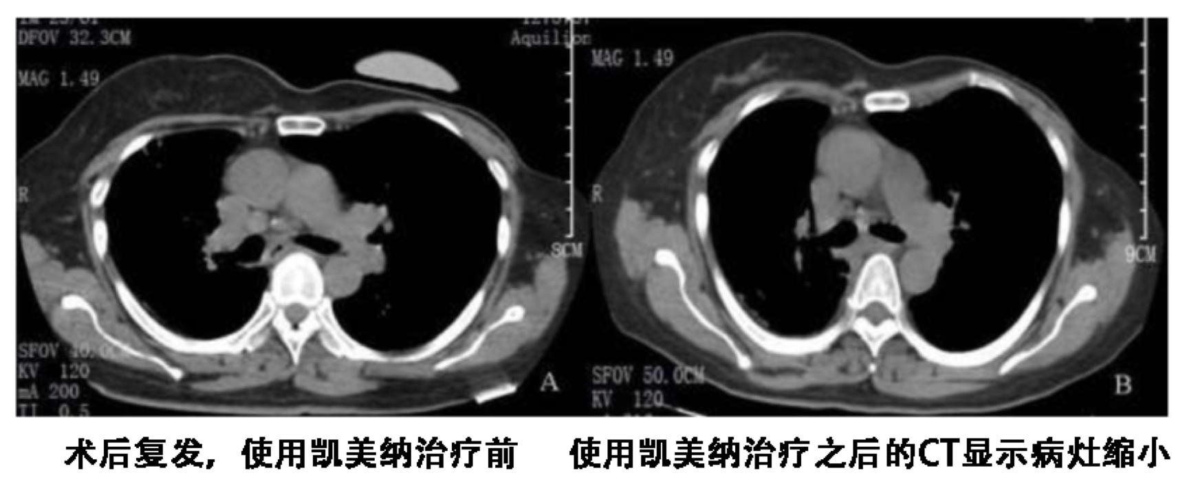 肺癌EGFR基因黄金突变的“反面”可以用靶向药物吗?