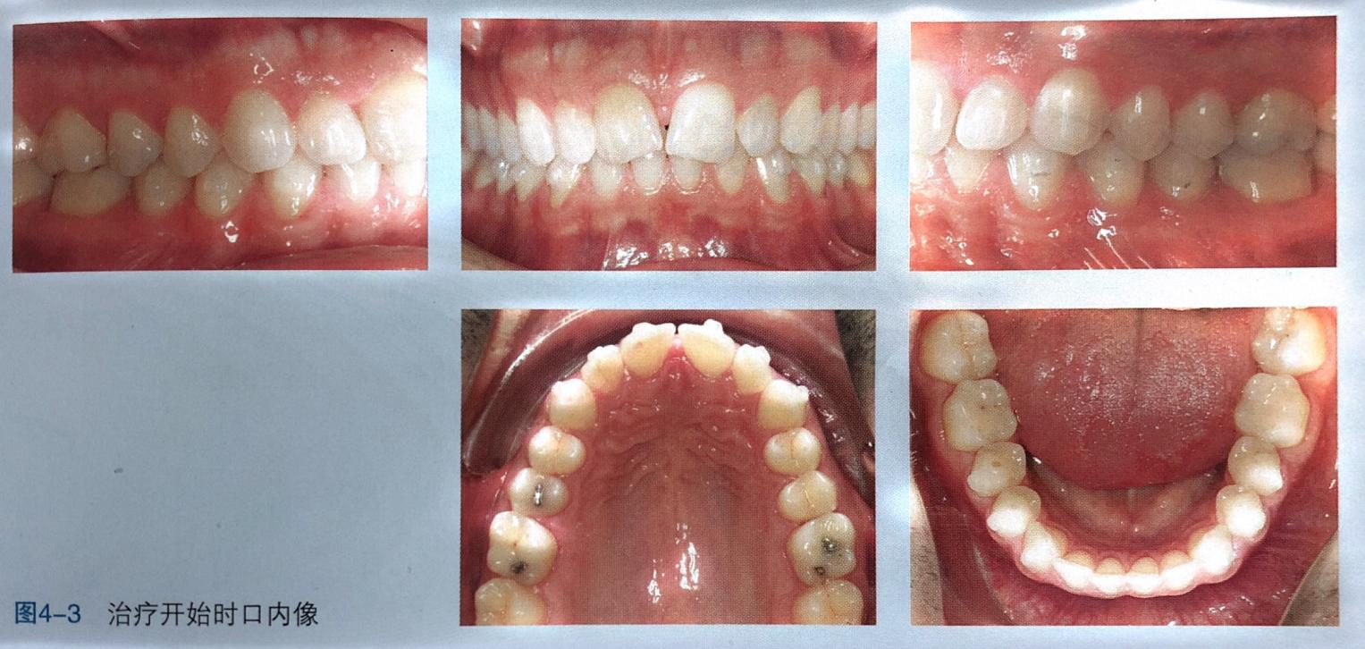 牙齿上的黑三角怎么去除,去除牙齿黑三角的神器
