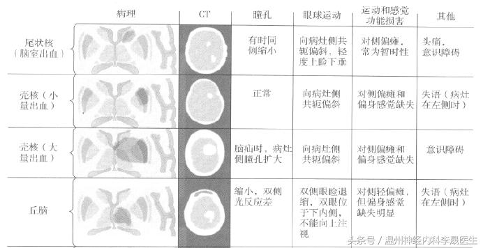 脑出血李医生,脑出血病例分析及答案