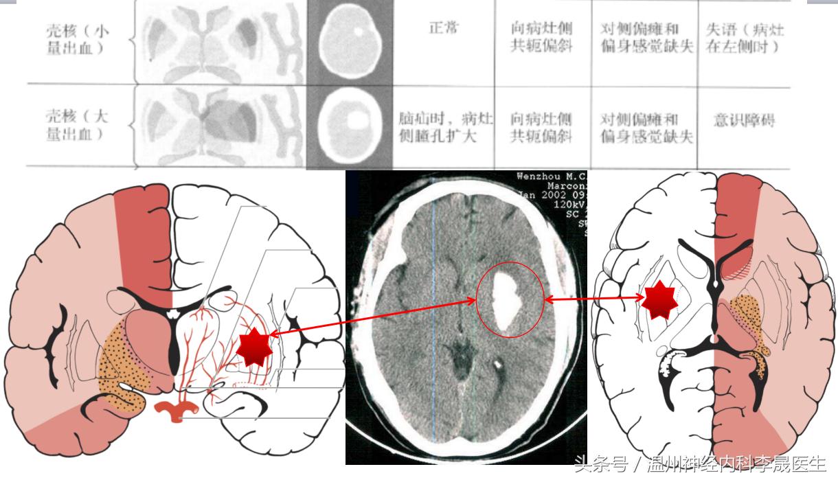 脑出血李医生,脑出血病例分析及答案
