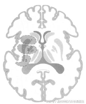 脑出血李医生,脑出血病例分析及答案