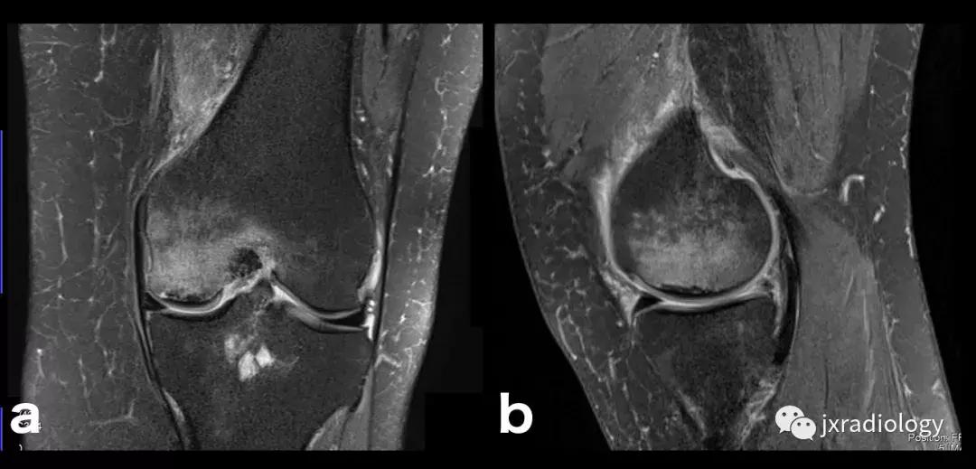膝关节骨髓水肿疼痛特点,膝关节骨髓水肿的临床表现