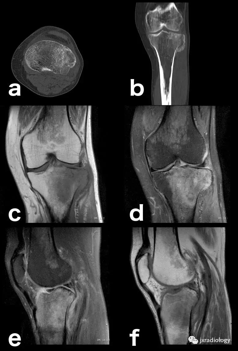 膝关节骨髓水肿疼痛特点,膝关节骨髓水肿的临床表现