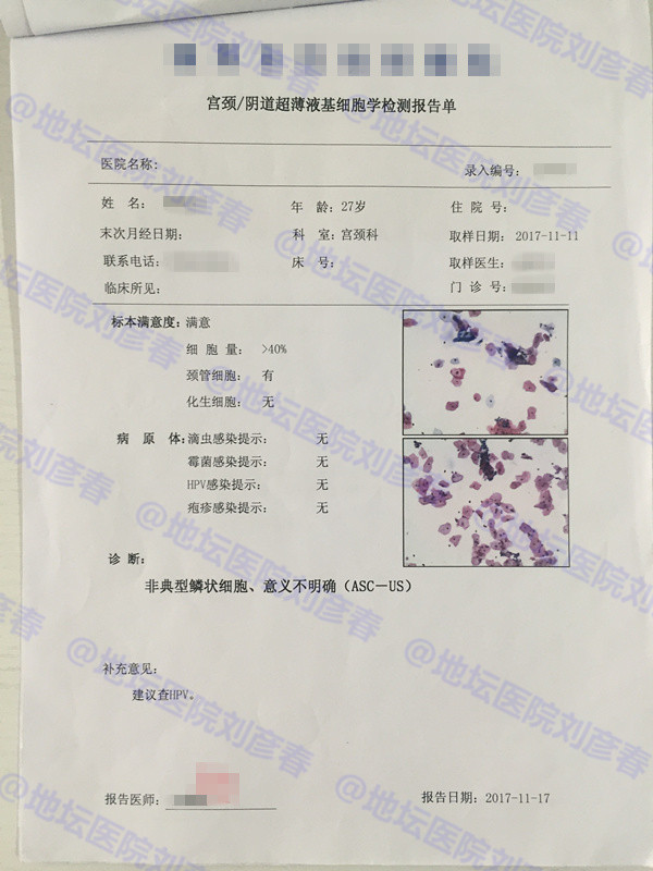 宫颈cin3累及腺体排除宫颈病变,宫颈高度病变cin3累及腺体是癌吗
