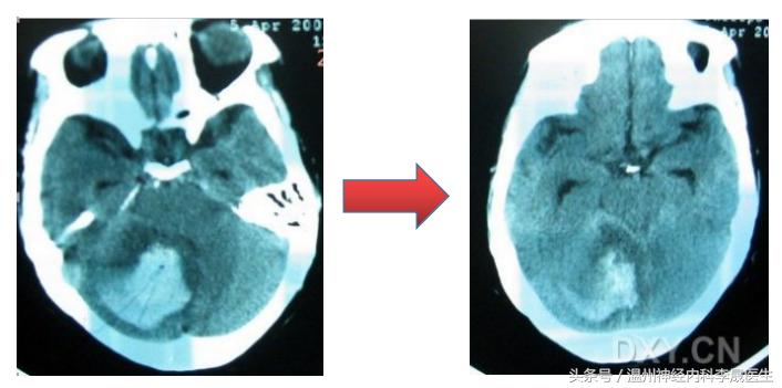 简述脑出血的内科治疗,脑出血中医解析