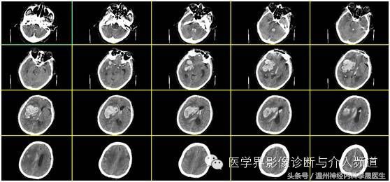 专家讲解中医治疗脑出血视频,医生对脑出血病人的治疗