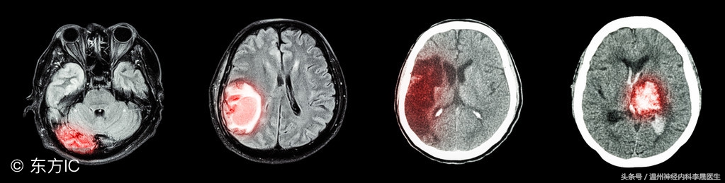 专家讲解中医治疗脑出血视频,医生对脑出血病人的治疗