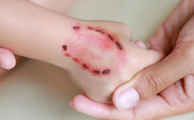 狗咬伤打了疫苗还会得狂犬病吗,狂犬病疫苗超过24小时打还有效吗