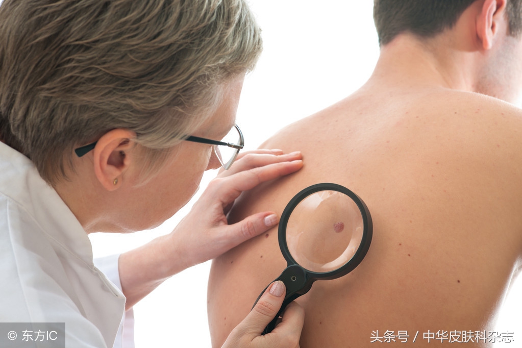 如何识别恶性痣,介于良性和恶性之间的结膜色素痣