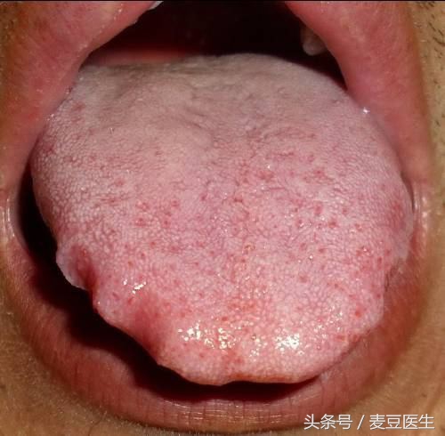 最全中医舌诊图谱来啦!看舌头,知全身!