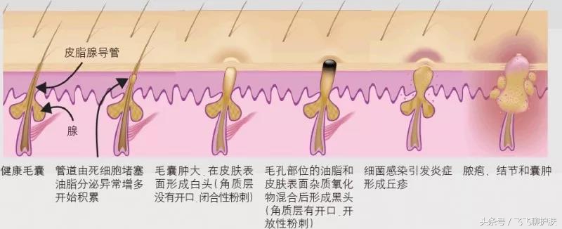 大概只有自己最清楚为什么长痘,各种痘痘类型都是如何产生的